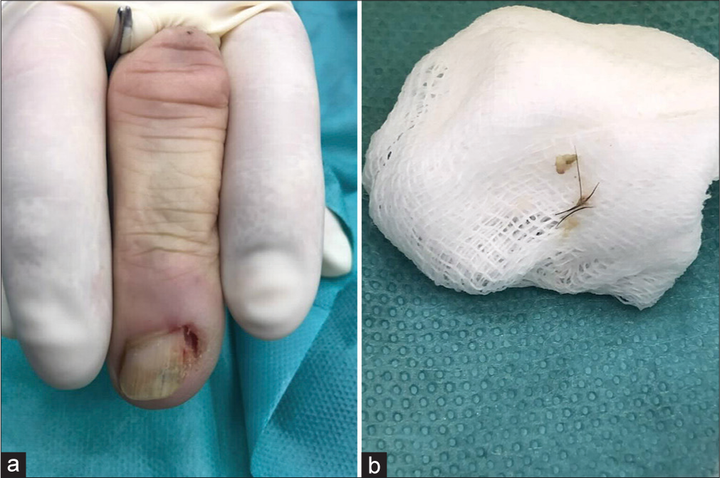 (a) The affected radial nail plate margin has been avulsed. (b) Cow hairs extracted from under the proximal nail fold.