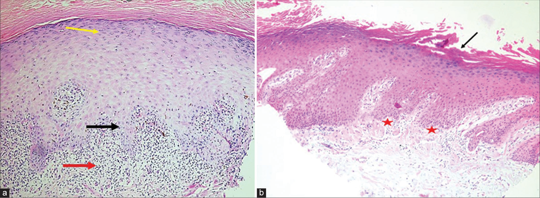 (a) Skin biopsy showing hyperkeratosis, hypergranulosis (yellow arrow), basal layer degeneration (black arrow) and a band of lymphocytic infiltration (red arrow) in the dermis (Haematoxylin and Eosin [H&E], ×400). (b) Nail bed biopsy showing psoriasiform hyperplasia of nail bed epithelium with hyperkeratosis and parakeratosis (black arrow) and regular elongation of rete ridges (red star) (H&E, ×400).