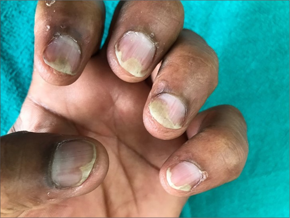 Nail psoriasis affecting all fingernails, modified DLQI score: 12.