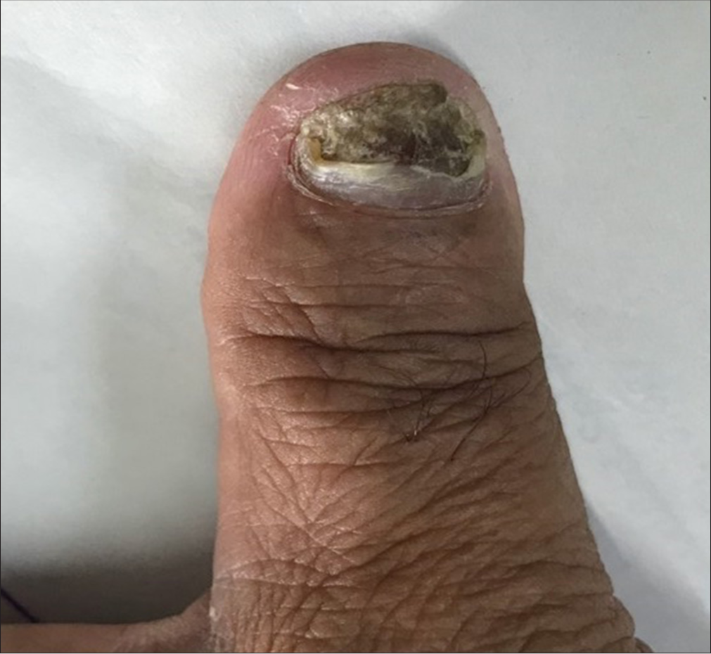 Onychomycosis of thumbnail, modified DLQI score: 13.