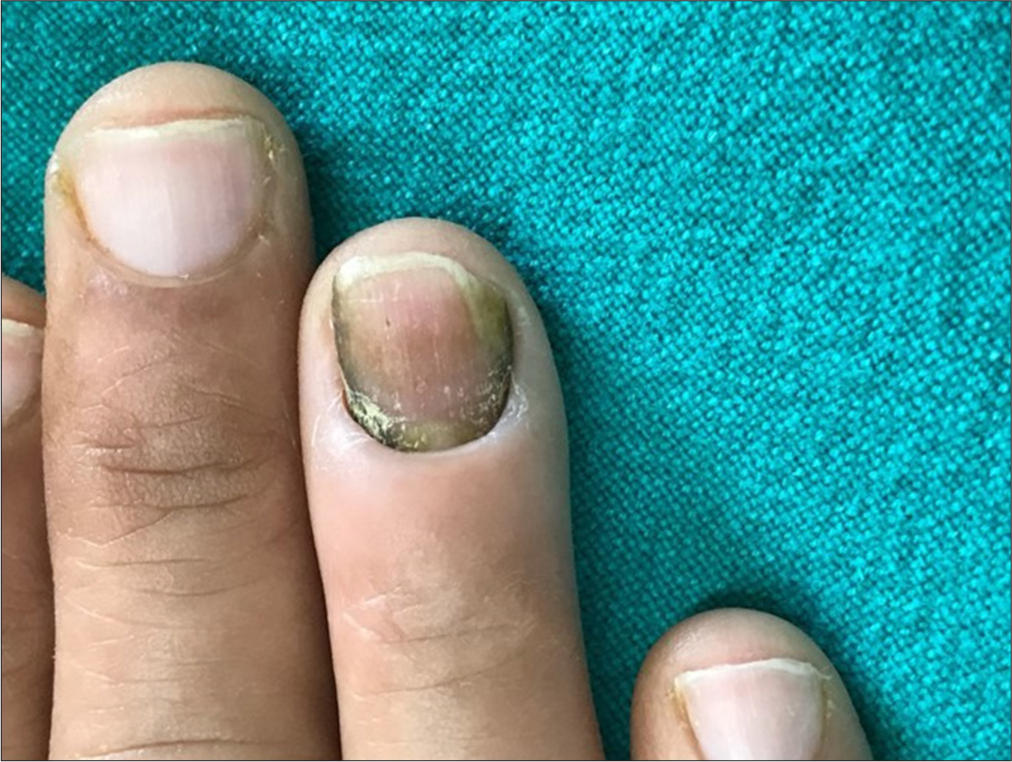 Chronic Paronychia of right ring finger, modified DLQI score: 9.