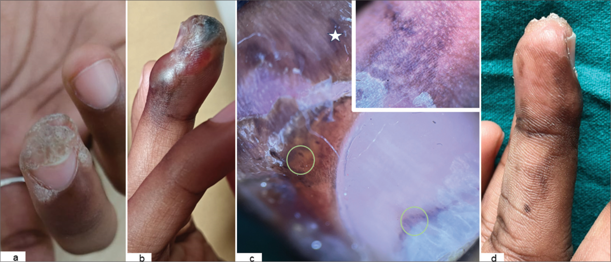 (a) Baseline photograph showing the periungual wart. (b) Tense bullae over proximal and lateral nail fold with black eschar over the hyponychium. (c) Dermoscopy (DermLite DL100, Polarised×10) revealing the presence of splinter haemorrhages (yellow Circle) and blue-grey clods (star). Figure inset showing increased pigment network. (d) Four weeks follow-up showing residual hyperpigmentation of digit.