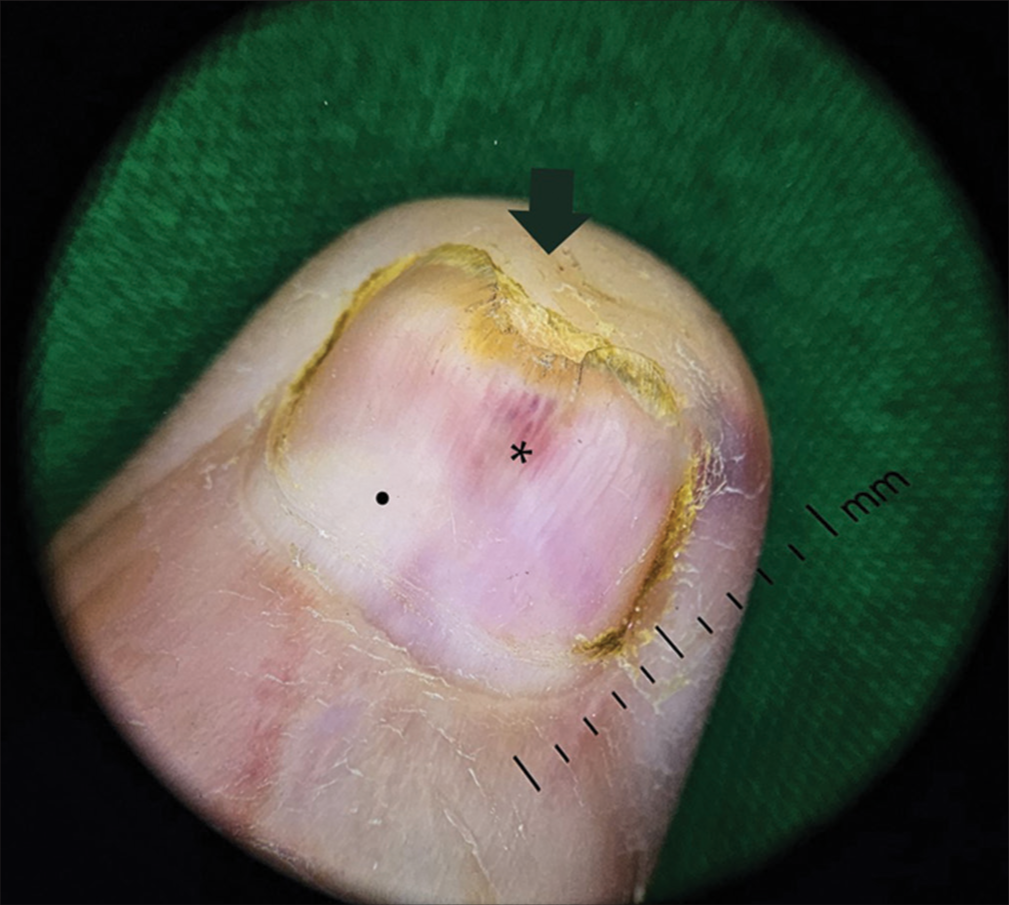 Onychoscopy showing distal onycholysis, marginal yellowish discolouration, nail-bed erythema (black arrow), splinter haemorrhages (*), and distorted lunula (.) in the first case.