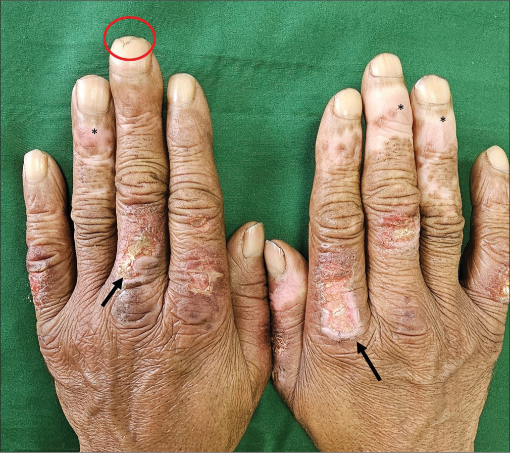 57-year-old man who presented with chilblains, clinical image showing fingers with tender violaceous plaque, erosions with crusting (arrow), hypopigmented scarring over periungual and distal areas (*), distal onycholysis and nail pallor (circle).