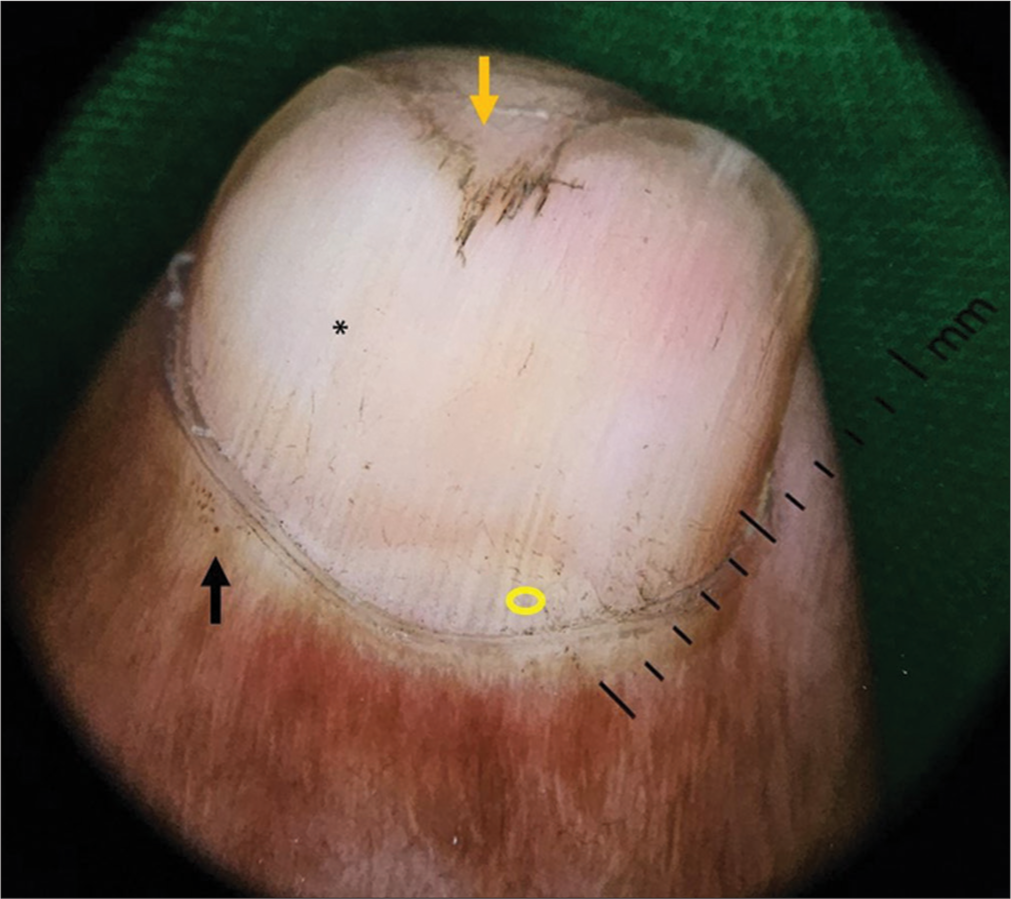 Onychoscopy of the left middle finger showing distorted lunula (circle), distal onycholysis (yellow arrow), nail pallor (*) and microhemorrhages over proximal nail fold (black arrow) in the second case.