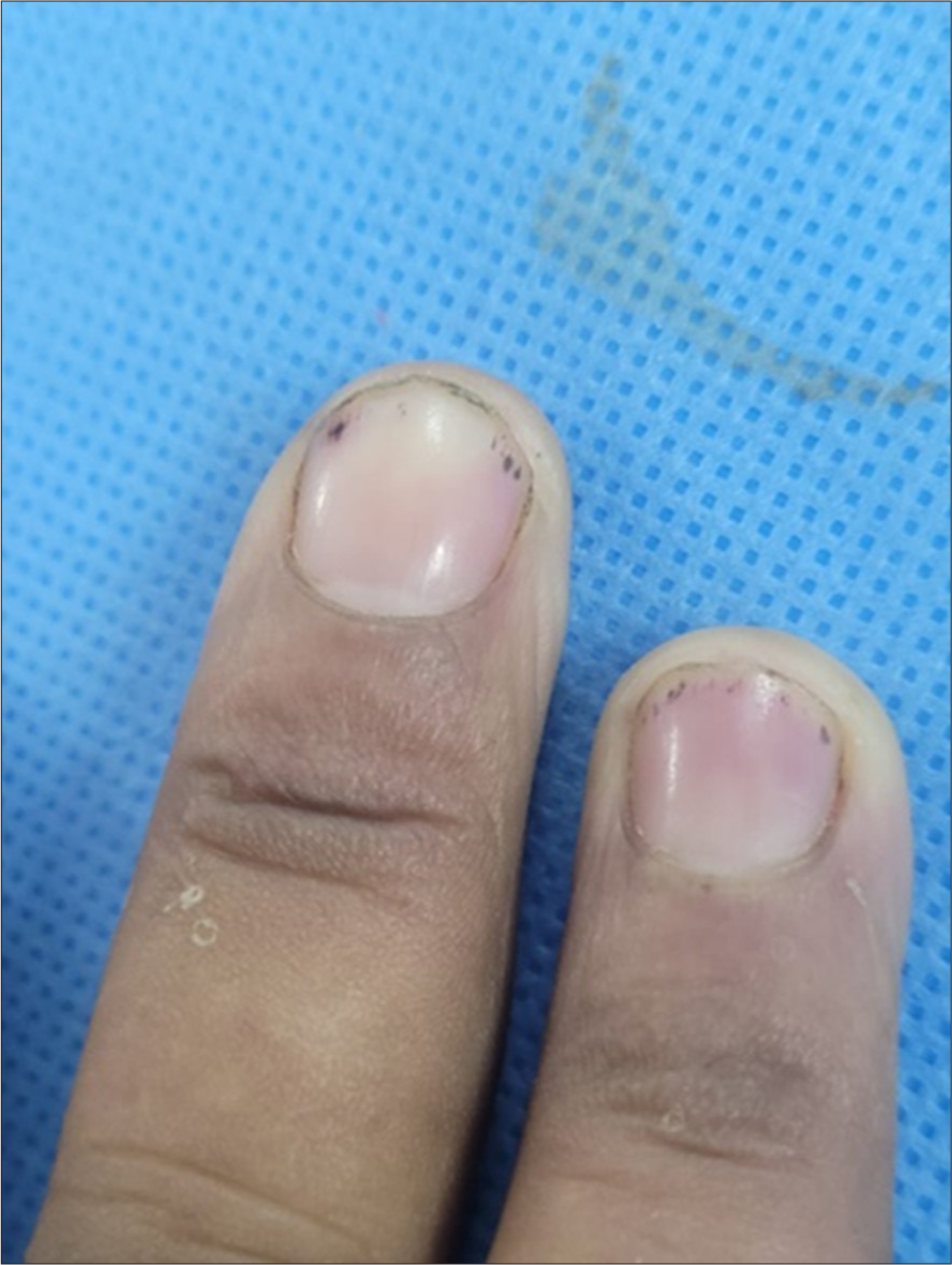 Splinter haemorrhages in nail plate.