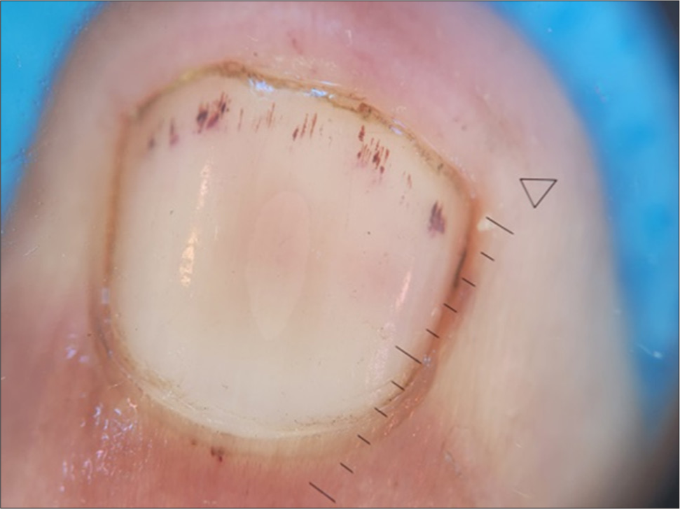 Onychoscopy showing splinter nail hemorrhages [heine delta 30 dermoscope ×10]