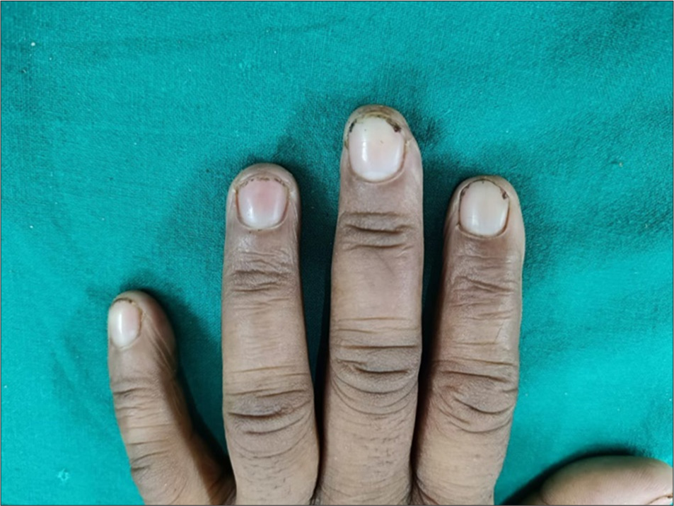 Normal nail plate after treatment.