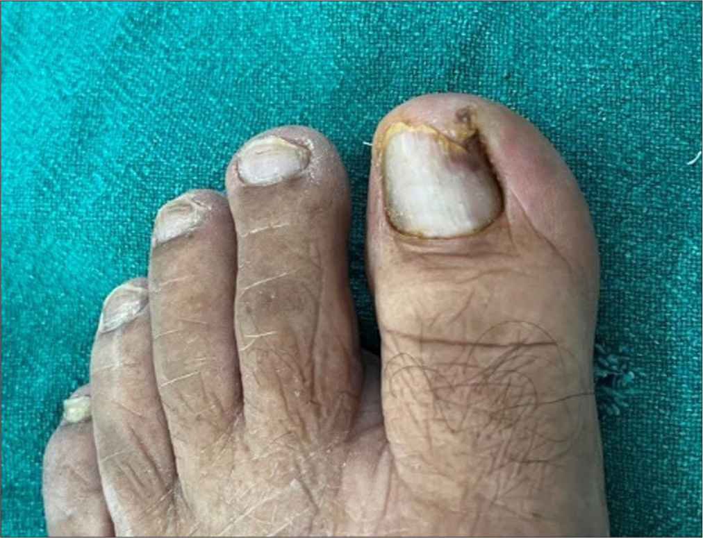 Distal-lateral ingrown toe nail of left hallux.