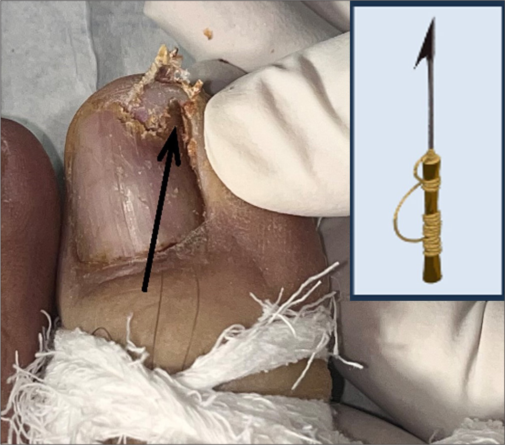 Intraoperative view showing the harpoon nail. Lateral most part of the nail plate is forming a spicule (arrow) and piercing the lateral nail groove. Inset shows a harpoon, an instrument for hunting.