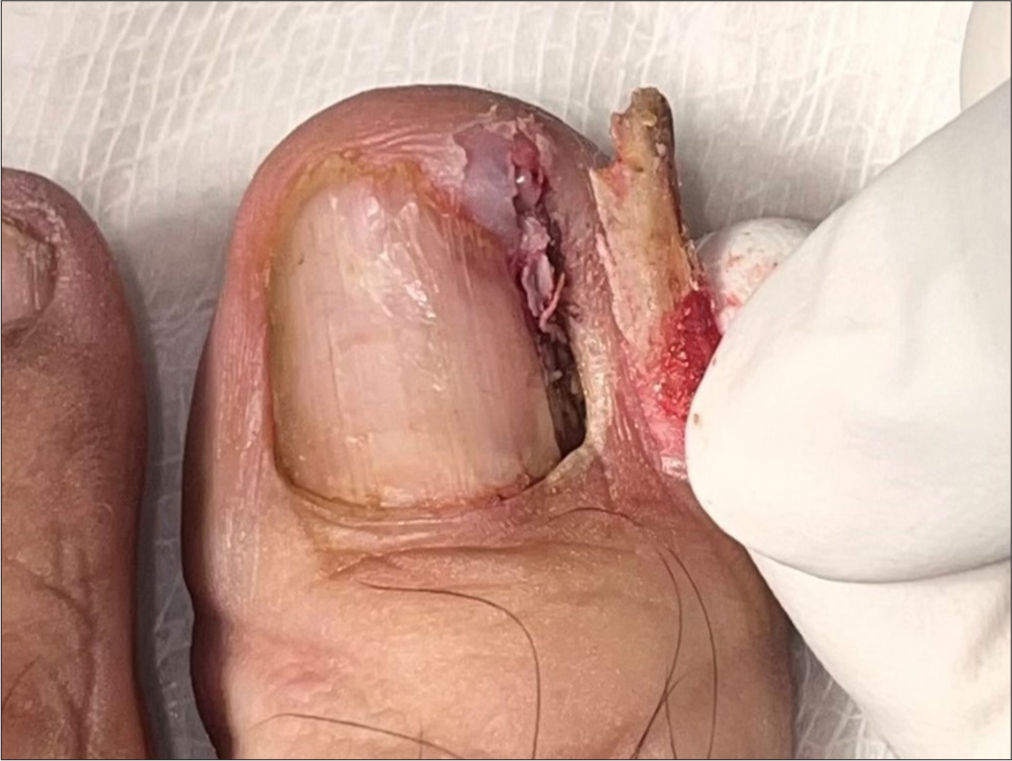 Lateral partial avulsion of nail plate showing its morphology with sharp end and broad base.