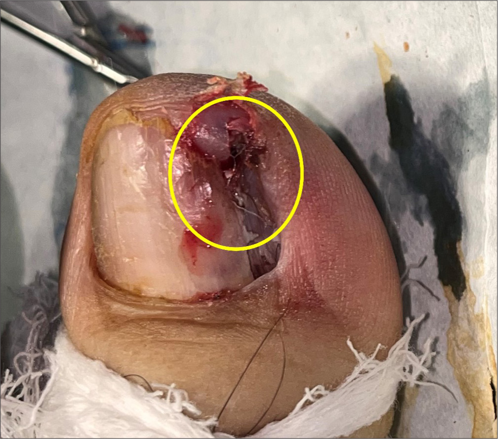 Epithelialized tunnel (circled) created by the harpoon nail, which has been deroofed after lateral partial nail avulsion.