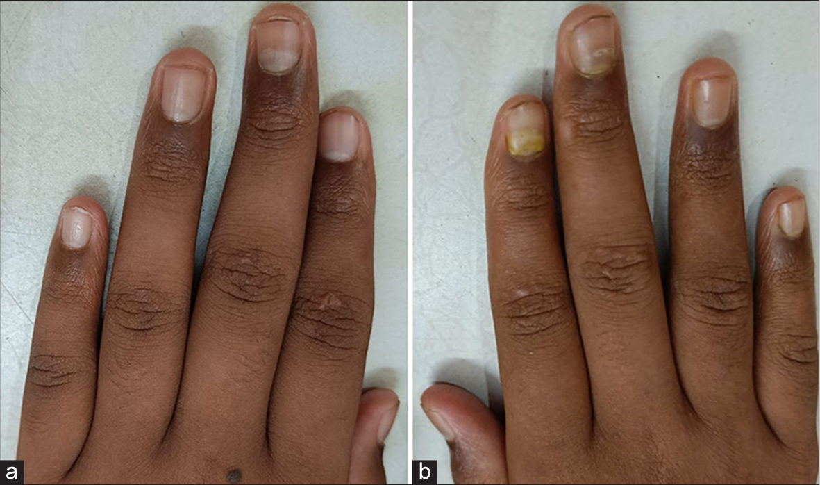 Clinical image showing onychomadesis involving the index and middle finger of the (a) left hand and (b) middle finger of the right hand.