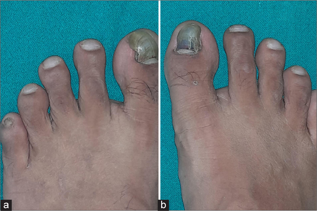 Depicting (a) right and (b) left foot of the patient.