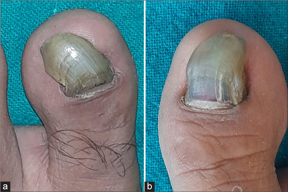 Showing (a) right and (b) left toenail of the patient. Significant thickening, increased curvature, discolouration of nail plate and malalignment of great toenails.