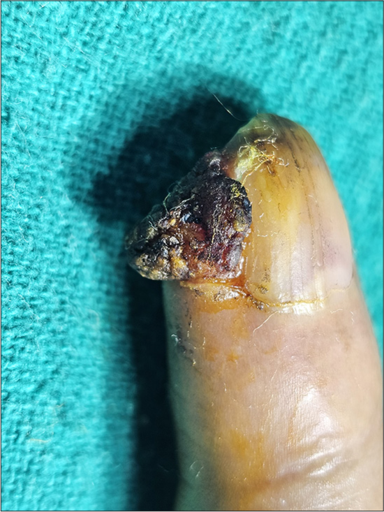 A well-defined, erythematous and hypertrophic plaque with overlying haemorrhagic crusts, present on the periungual aspect of the right index finger.