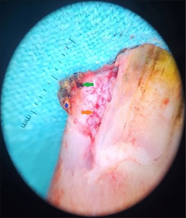 Onychoscopy showing superficial white scales, white structureless areas (blue star), blood clots (green arrow), and linear and irregular vessels (orange arrow).