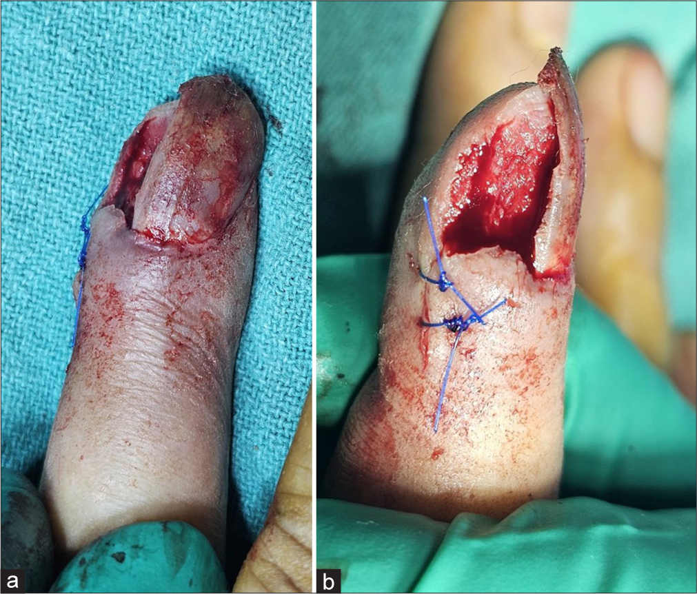 (a) Appearance of finger post-procedure. (b) Side view of finger post-procedure.