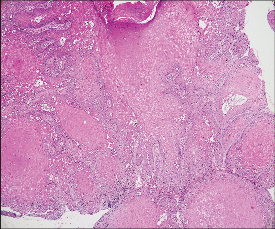 Nests of atypical squamous cells with abundant eosinophilic cytoplasm, with vesicular and hyperchromatic nuclei, extending into the entire epidermis and dermis (Hematoxylin and eosin ×40).