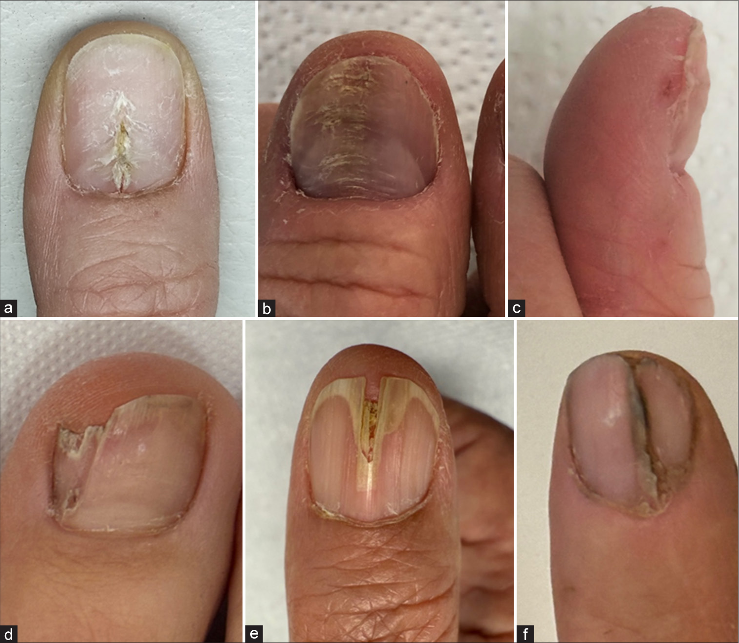 Nails with longitudinal median or paramedian dystrophy. (a) Thumbnail showing median canaliform dystrophy demonstrating a median split in the proximal part of the nail plate with oblique furrows giving the aspect of a fir tree. (b) Another thumbnail showing habit-tic deformity with enormous enlargement of the lunula, loss of the cuticle and wash-board appearance due to serial short transverse furrows and signs of skin picking. (c) Thumbnail with habit-tic deformity seen from the side exhibits a deep depression in the proximal nail region, thickening of the free margin of the proximal nail fold, loss of cuticle and severe perionychotillomania. (d) Great toenail showing a paramedian intraungual fibrokeratoma causing ‘solenonychia’. (e) Thumbnail showing onychopapilloma in median location. (f) Traumatic nail split.