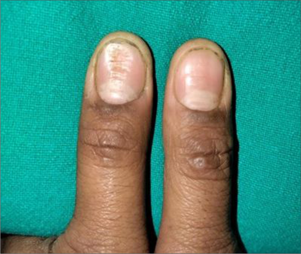 Washboard nail deformity of the left thumb nail in a 27-year-old male patient.