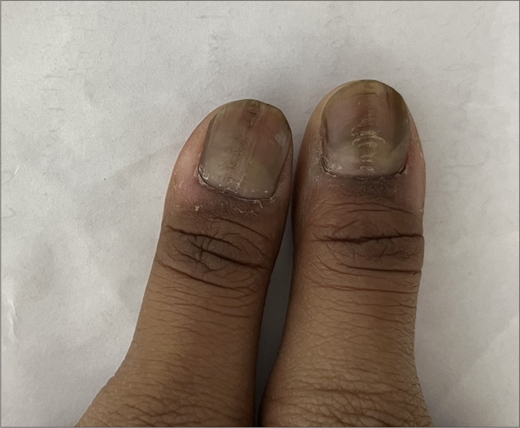 Washboard nails bilaterally in a 14-year-old female patient.