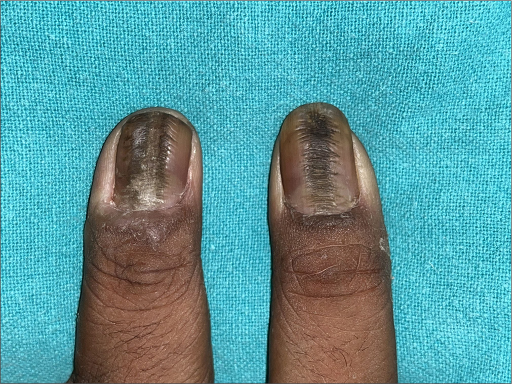 Washboard nail bilaterally in a 34-year-old male patient.