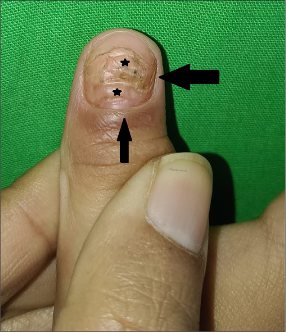 8-year-old male child showing retraction of nail fold (arrow), horizontal splits (upper star) and absent lunula (lower star) of the left thumb nail.