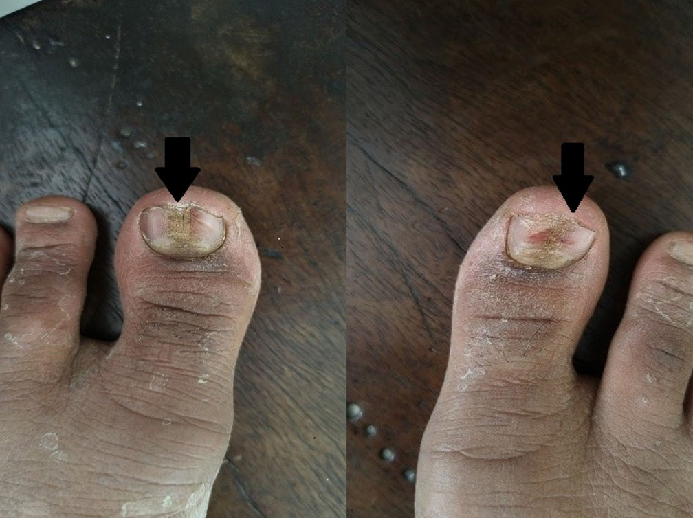A 68-year-old male presented to us with a midline split and outward ridges from the center (arrow) with minimal nail fold changes present over bilateral great toenails.