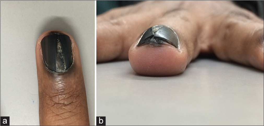 Right middle fingernail of an Indian immigrant to Switzerland with a far-advanced subungual melanoma. (a) Dorsal view. (b) Acral view. Note the massive increase in volume of the nail matrix and bed with a broad split of the nail plate, which is wider proximally than distally. (a) There is both Hutchinson as well as pseudo-Hutchinson sign on the proximal nail fold. (b) The Hutchinson sign is extending beyond the hyponychium.