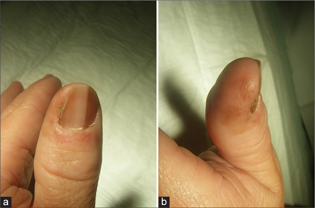 Melanoma in-situ of the right thumb nail of a 51-year-old female patient. Note the extensive periungual pigmentation that extends to the ulnar side of the distal phalanx, while the darker melanonychia is on the radial side of the thumbnail. (a) Irregular melanonychia, more pronounced on the radial side of the thumb nail. (b) Extensive periungual pigmentation, more pronounced on the ulnar side of the thumb’s distal phalanx.