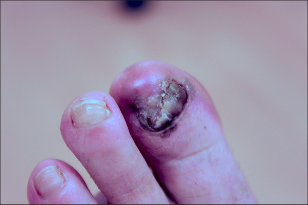 Long-standing advanced subungual melanoma of the left big toe in a 48-year-old female patient. There is severe nail dystrophy and periungual pigmentation on the proximal nail fold, extending over the hyponychium onto the tip of the toe.
