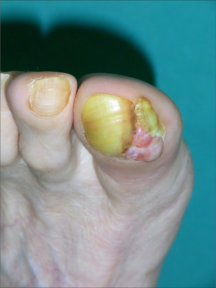 Amelanotic melanoma misdiagnosed and treated as a wart for many years. The patient had inguinal lymph node metastases at the time of consultation.