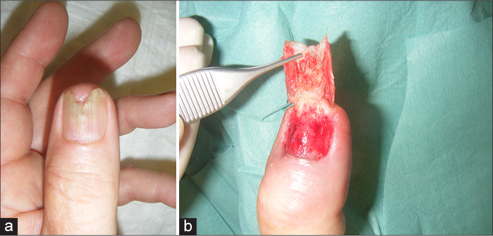 Subungual amelanotic melanoma of the left thumb in a 62-year-old man. (a) The suspected clinical diagnosis was a subungual fibrokeratoma under an area of onycholysis. (b) After nail avulsion, the differential diagnosis entertained were squamous cell carcinoma and amelanotic melanoma. Histopathology confirmed the diagnosis of an amelanotic nail bed melanoma.