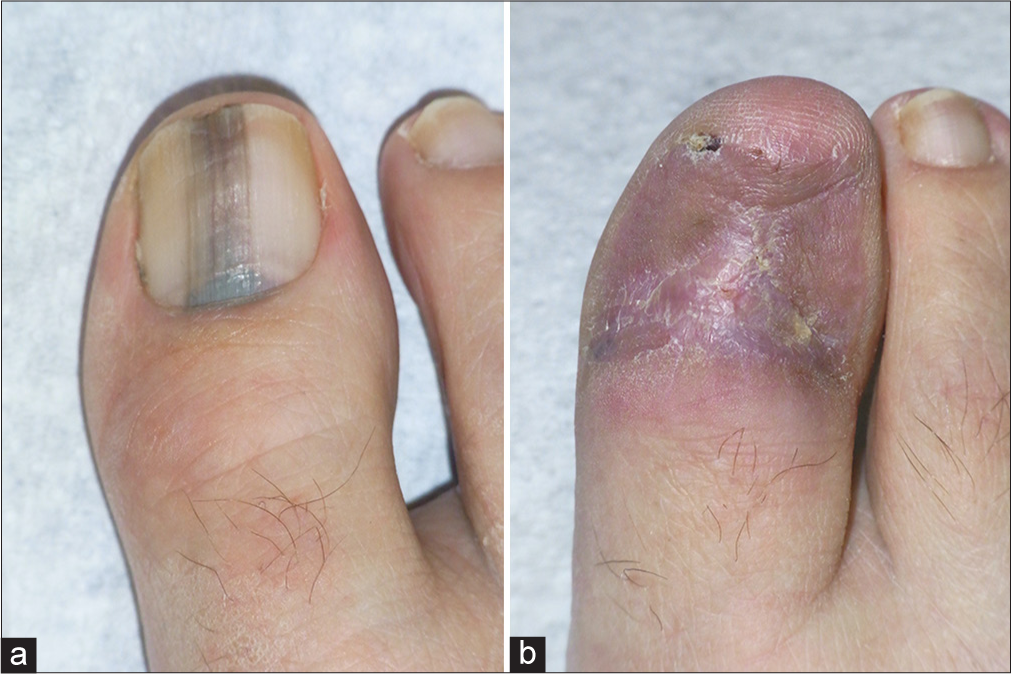 Early invasive subungual melanoma. Breslow index 0.7 mm. (a) Dorsal view. (b) Eight weeks after wide local excision and healing by secondary intention.