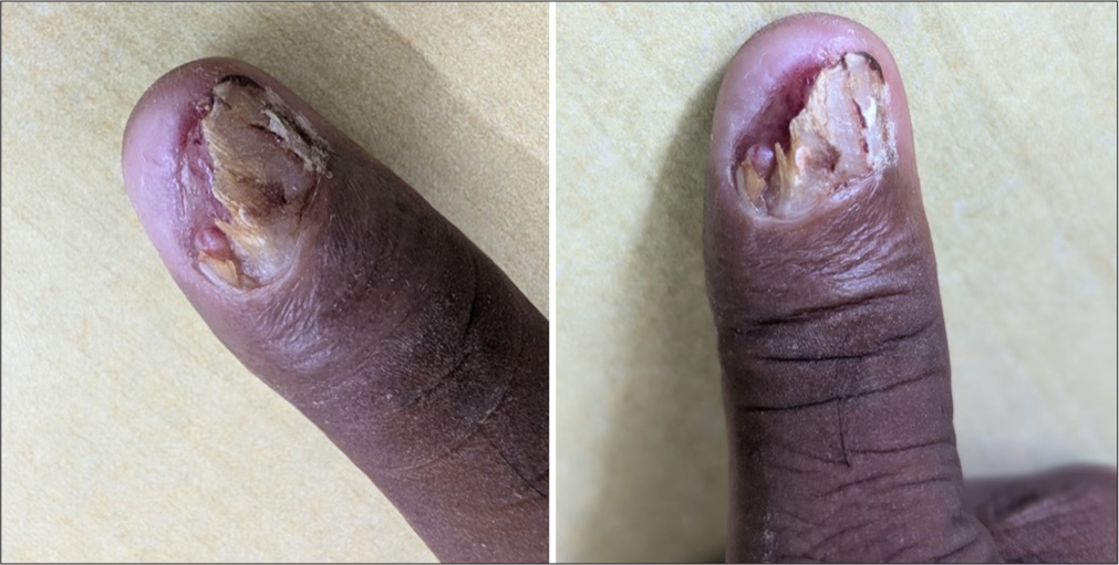 Onychodystrophy with yellowish discolouration of nail plate with subungual hyperkeratosis of the left thumb.