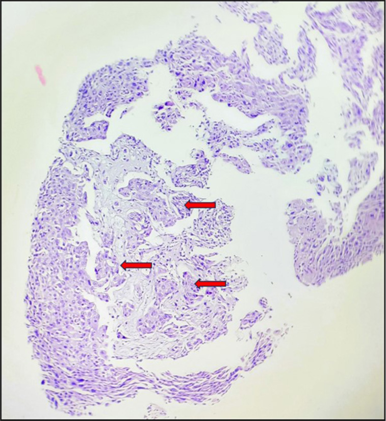 Section showing infiltration of malignant squamous cells into the underlying dermis, with neoplastic cells showing round nuclei, basophilic cytoplasm, and mild to moderate nuclear polymorphism (red arrows) (H&E, ×100). H&E: Hematoxylin and eosin.