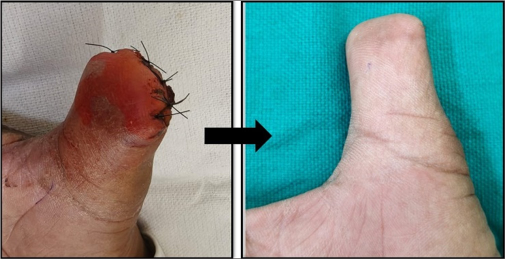 Distal interphalangeal joint disarticulation of the left thumb with flap reconstruction shown immediately post-surgery (left) and after 6 weeks (right).