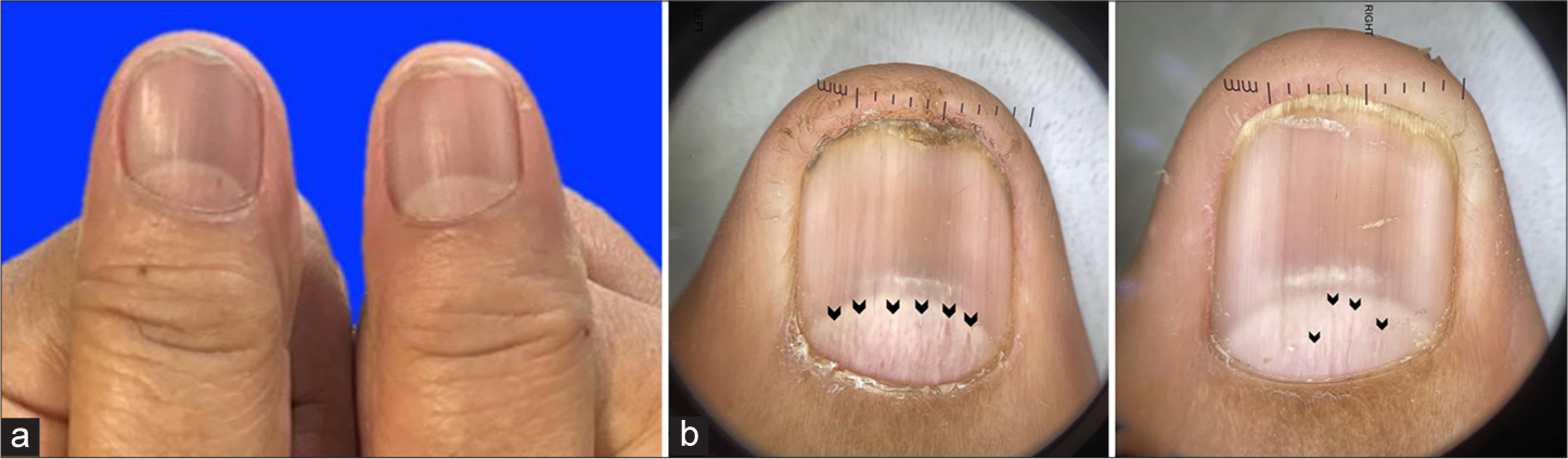 (a) Dermatologic examination shows distal nail splitting with longitudinal brown streaks on both thumbnails. (b) Polarised dermoscopy demonstrates longitudinal melanonychia, splinter hemorrhages on the lunula (black arrows), onychoschizia, transverse bands of leuconychia, and ragged cuticles.