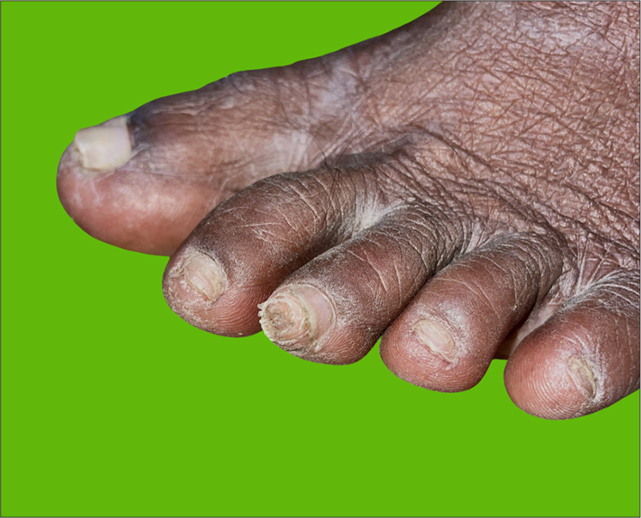 A small bony protuberance arising from the phalangeal tuft of mid toe.
