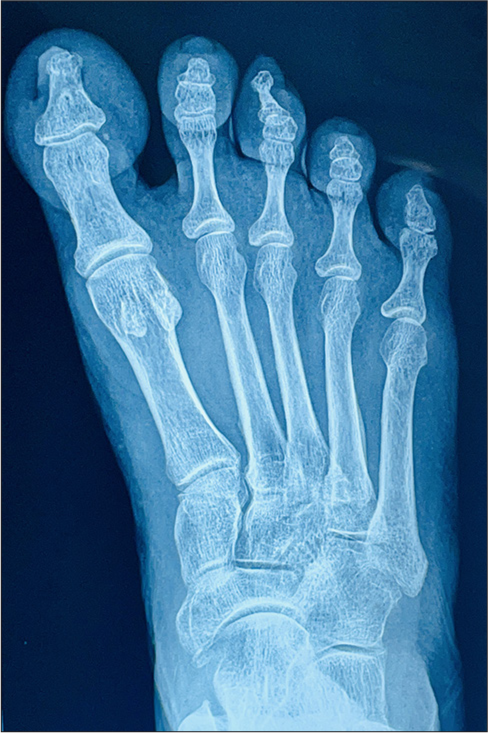 An anteroposterior view of the left foot shows a small exophytic bony lesion is seen arising from the tuft of middle toe showing no obvious continuity with medulla of phalanx- subungual exostosis. There is sclerosis of this phalangeal shaft. No associated cortical irregularity, periosteal reaction or soft tissue component is seen.